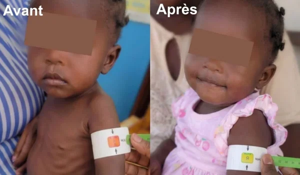 More than 5,000 haitian children treated for acute malnutrition